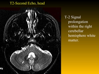 T2-Second Echo, head T-2 Signal prolongation within the right cerebellar hemisphere white matter. 