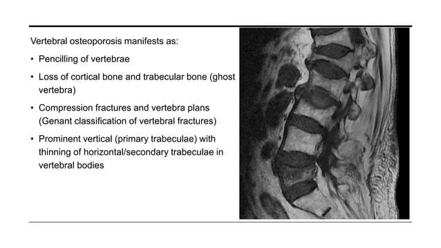 Vertebral Pathologies Vertebral column associated pathology and radiographic appearance | PPT