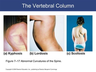 Copyright © 2009 Pearson Education, Inc., publishing as Pearson Benjamin Cummings
The Vertebral Column
Figure 7–17 Abnormal Curvatures of the Spine.
 