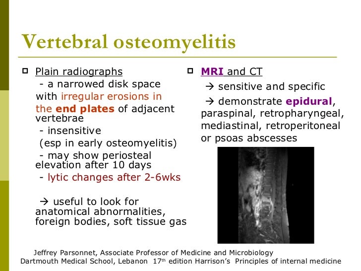 Vertebral osteomyelitis