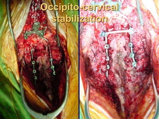 Occipito-cervical
stabilization
 
