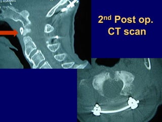 2nd Post op.
CT scan
 
