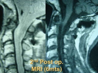 2nd Post op.
MRI (6mts)
 