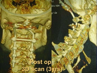 Post op.
3D scan (3yrs)
 
