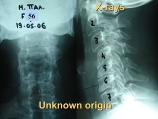 56
X-rays
Unknown origin
 