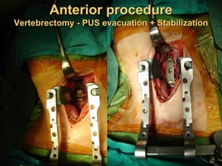 Anterior procedure
Vertebrectomy - PUS evacuation + Stabilization
 