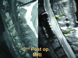 2nd Post op.
MRI
 