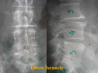 Elbow furuncle
 