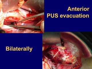 Anterior
PUS evacuation
Bilaterally
 