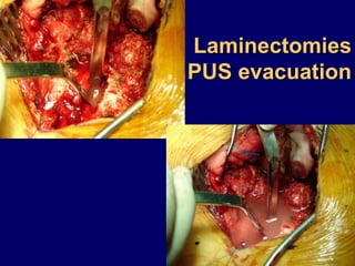 Laminectomies
PUS evacuation
 