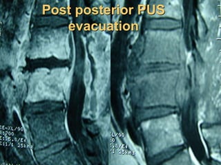 Post posterior PUS
evacuation
 