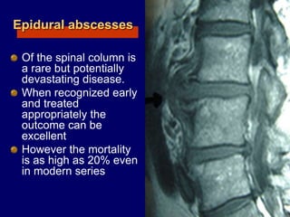 Epidural abscesses
Of the spinal column is
a rare but potentially
devastating disease.
When recognized early
and treated
appropriately the
outcome can be
excellent
However the mortality
is as high as 20% even
in modern series
 