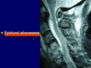 Epidural abscesses
 