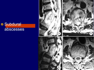 Subdural
abscesses
 