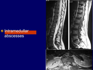 Intramedullar
abscesses
 
