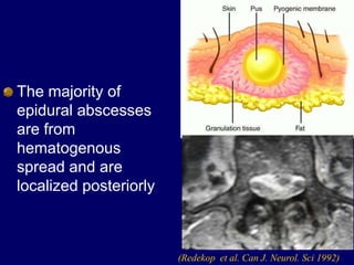 The majority of
epidural abscesses
are from
hematogenous
spread and are
localized posteriorly
(Redekop et al. Can J. Neurol. Sci 1992)
 