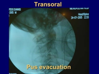 Transoral
Pus evacuation
 