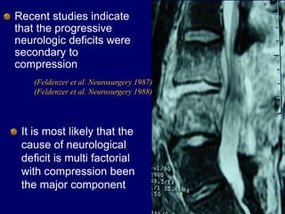 Recent studies indicate
that the progressive
neurologic deficits were
secondary to
compression
(Feldenzer et al. Neurosurgery 1987)
(Feldenzer et al. Neurosurgery 1988)
It is most likely that the
cause of neurological
deficit is multi factorial
with compression been
the major component
 