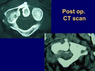 Post op.
CT scan
 