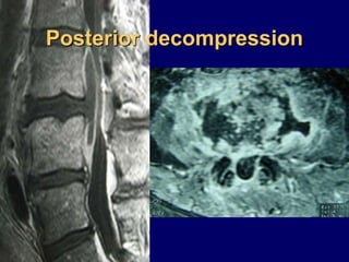 Posterior decompression
 