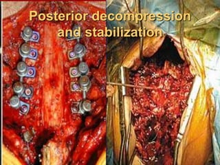 Posterior decompression
and stabilization
 