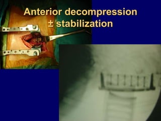 Anterior decompression
± stabilization
 