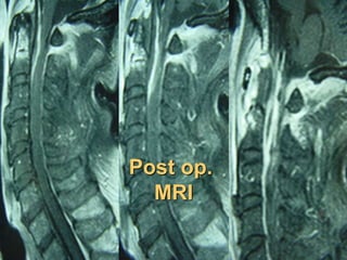 Post op.
MRI
 