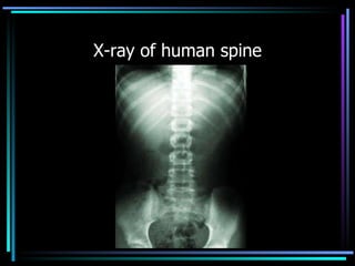 X-ray of human spine 