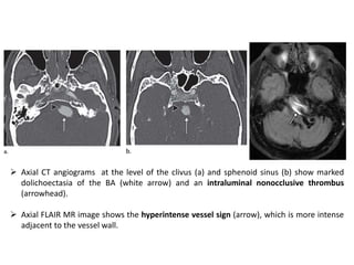  Axial CT angiograms at the level of the clivus (a) and sphenoid sinus (b) show marked
dolichoectasia of the BA (white arrow) and an intraluminal nonocclusive thrombus
(arrowhead).
 Axial FLAIR MR image shows the hyperintense vessel sign (arrow), which is more intense
adjacent to the vessel wall.
 