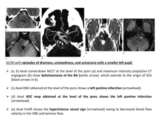 65/M with episodes of dizziness, unsteadiness, and anisocoria with a smaller left pupil.
 (a, b) Axial coned-down NCCT at the level of the pons (a) and maximum intensity projection CT
angiogram (b) show dolichoectasia of the BA (white arrow), which extends to the origin of SCA
(black arrows in b).
 (c) Axial DWI obtained at the level of the pons shows a left pontine infarction (arrowhead).
 (d) Axial ADC map obtained at the level of the pons shows the left pontine infarction
(arrowhead).
 (e) Axial FLAIR shows the hyperintense vessel sign (arrowhead) owing to decreased blood flow
velocity in the VBD and laminar flow.
 