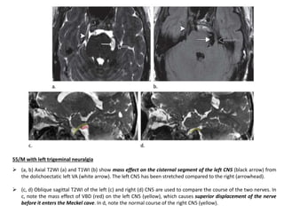 55/M with left trigeminal neuralgia
 (a, b) Axial T2WI (a) and T1WI (b) show mass effect on the cisternal segment of the left CN5 (black arrow) from
the dolichoectatic left VA (white arrow). The left CN5 has been stretched compared to the right (arrowhead).
 (c, d) Oblique sagittal T2WI of the left (c) and right (d) CN5 are used to compare the course of the two nerves. In
c, note the mass effect of VBD (red) on the left CN5 (yellow), which causes superior displacement of the nerve
before it enters the Meckel cave. In d, note the normal course of the right CN5 (yellow).
 