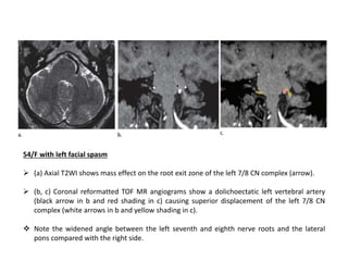 54/F with left facial spasm
 (a) Axial T2WI shows mass effect on the root exit zone of the left 7/8 CN complex (arrow).
 (b, c) Coronal reformatted TOF MR angiograms show a dolichoectatic left vertebral artery
(black arrow in b and red shading in c) causing superior displacement of the left 7/8 CN
complex (white arrows in b and yellow shading in c).
 Note the widened angle between the left seventh and eighth nerve roots and the lateral
pons compared with the right side.
 