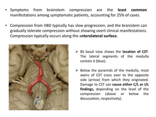 • Symptoms from brainstem compression are the least common
manifestations among symptomatic patients, accounting for 25% of cases.
• Compression from VBD typically has slow progression, and the brainstem can
gradually tolerate compression without showing overt clinical manifestations.
Compression typically occurs along the anterolateral surface.
 BS basal view shows the location of CST.
The lateral segments of the medulla
contain it (blue).
 Below the pyramids of the medulla, most
axons of CST cross over to the opposite
side (arrow) from which they originated.
Damage to CST can cause either C/L or I/L
findings, depending on the level of the
compression (above or below the
decussation, respectively).
 