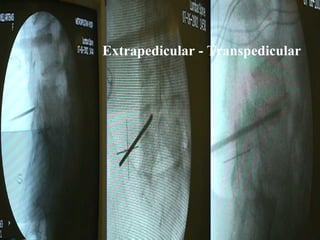 Vertebroplasty vs Kyphoplasty | PPT
