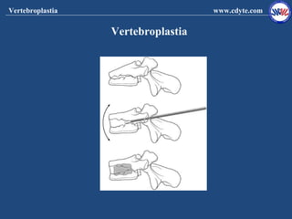 Vertebroplastia                     www.cdyte.com


                  Vertebroplastia
 