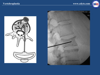Vertebroplastia   www.cdyte.com
 