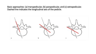 VERTEBROPLASTY AND KYPHOPLASTY- Eagle view | PPTX