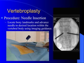 Vertebroplasty Procedure: Needle Insertion Locate bony landmarks and advance needle to desired location within the vertebral body using imaging guidance. 