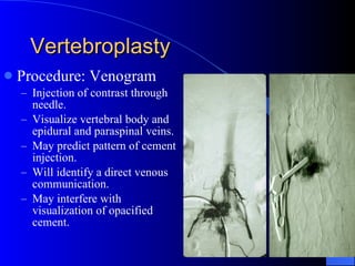 Vertebroplasty Procedure: Venogram Injection of contrast through needle. Visualize vertebral body and epidural and paraspinal veins. May predict pattern of cement injection. Will identify a direct venous communication. May interfere with visualization of opacified cement. 