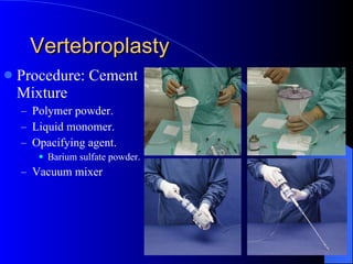 Vertebroplasty Procedure: Cement Mixture Polymer powder. Liquid monomer. Opacifying agent. Barium sulfate powder. Vacuum mixer 