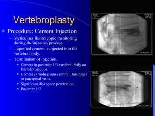 Vertebroplasty Procedure: Cement Injection Meticulous fluoroscopic monitoring during the injection process. Liquefied cement is injected into the vertebral body. Termination of injection. Cement in posterior 1/3 vertebral body on lateral projection. Cement extruding into epidural, foraminal or paraspinal veins. Significant disk space penetration. Posterior 1/3. 