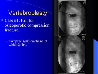 Vertebroplasty Case #1: Painful osteoporotic compression fracture. Complete symptomatic relief within 24 hrs. 