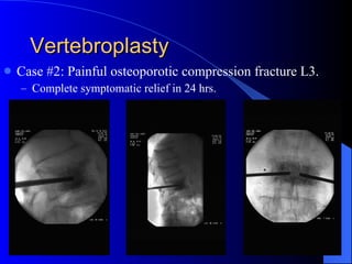 Vertebroplasty Case #2: Painful osteoporotic compression fracture L3. Complete symptomatic relief in 24 hrs. 