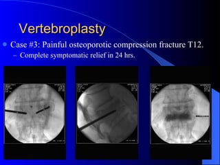 Vertebroplasty Case #3: Painful osteoporotic compression fracture T12. Complete symptomatic relief in 24 hrs. 