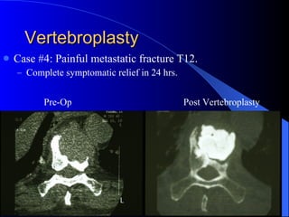 Vertebroplasty Case #4: Painful metastatic fracture T12. Complete symptomatic relief in 24 hrs. Pre-Op Post Vertebroplasty 