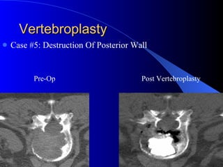 Vertebroplasty Case #5: Destruction Of Posterior Wall Pre-Op Post Vertebroplasty 