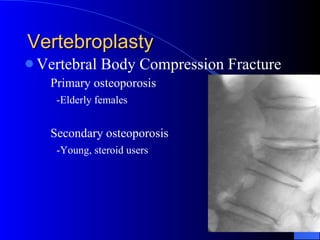 Vertebroplasty Vertebral Body Compression Fracture Primary osteoporosis -Elderly females Secondary osteoporosis -Young, steroid users 