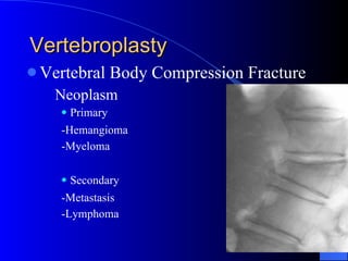 Vertebroplasty Vertebral Body Compression Fracture Neoplasm Primary -Hemangioma -Myeloma Secondary -Metastasis -Lymphoma 