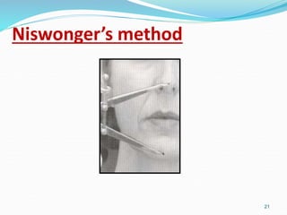 Niswonger’s method
21
 
