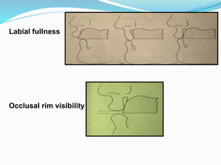 Labial fullness
Occlusal rim visibility
 